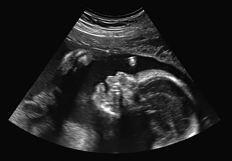 What is a prenatal ultrasound?